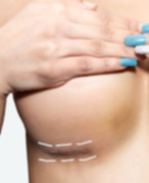 mamoplastia-de-aumento-1280x720_edited.j